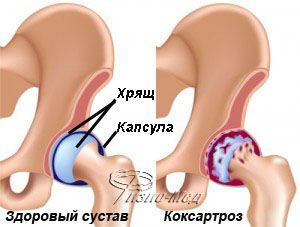 Коксартроз тазобедренного сустава - симптомы, лечение в Москве