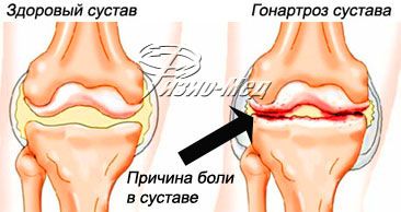 Остеоартрит коленного сустава (деформирующий артроз, гонартроз)